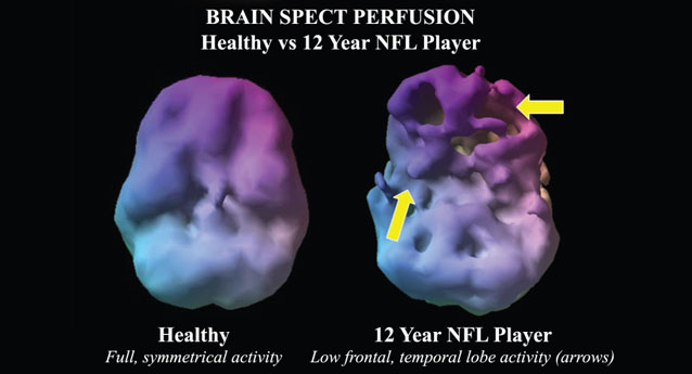 The NFL Brain Image